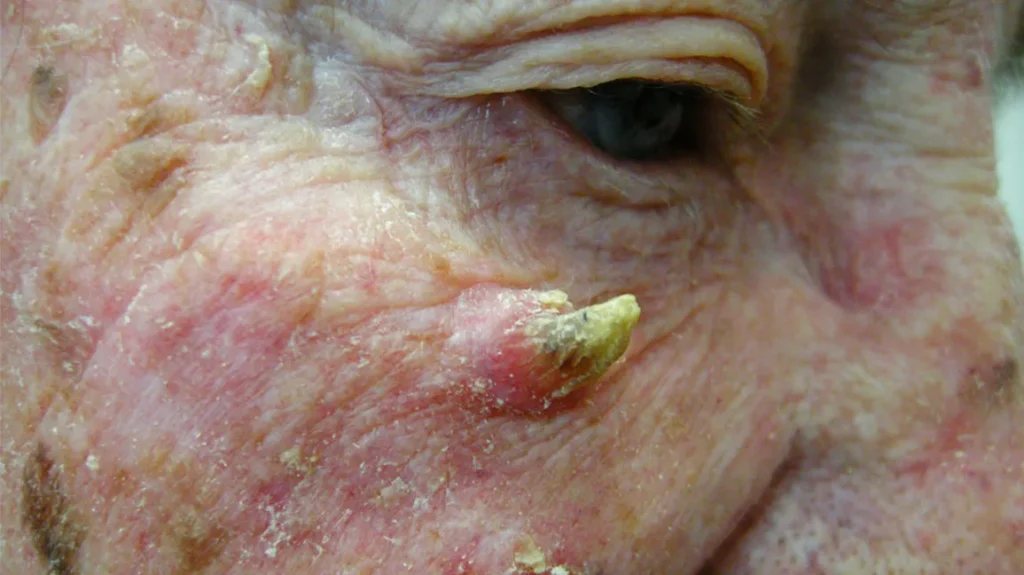 Squamous Cell Carcinoma- Cutaneous Horn - American Cancer Fund