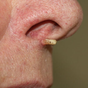 Squamous Cell Carcinoma- Cutaneous Horn - American Cancer Fund