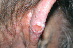 Squamous Cell Carcinoma- Symptoms Irregular Shape- American Cancer Fund Squamous Cell Carcinoma- Symptoms Irregular Shape- American Cancer Fund