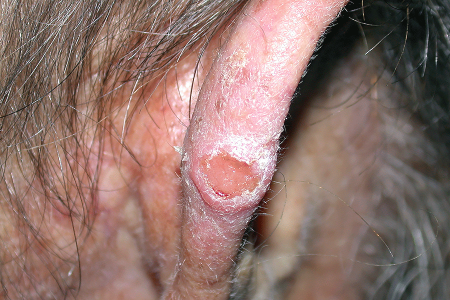 Squamous Cell Carcinoma- Symptoms Irregular Shape- American Cancer Fund