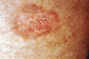 Squamous Cell Carcinoma- Symptoms Rough Skin- American Cancer Fund Squamous Cell Carcinoma- Symptoms Rough Skin- American Cancer Fund