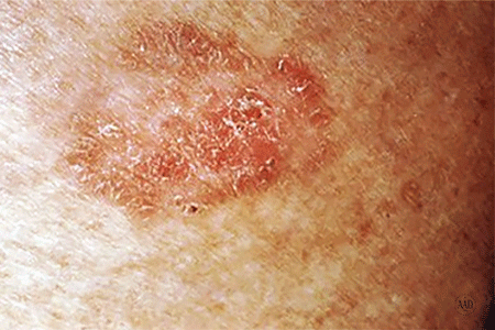 Squamous Cell Carcinoma- Symptoms Rough Skin- American Cancer Fund