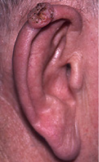 Squamous Cell Carcinoma on Ear- American Cancer Fund