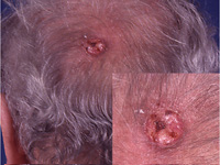 Squamous Cell Carcinoma on Scalp- American Cancer Fund